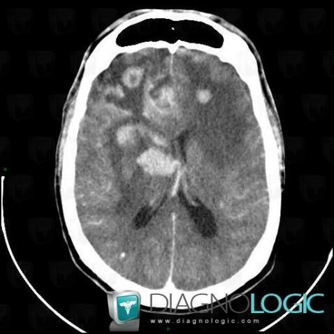 Lymphoma, Cortico subcortical region, Cerebral hemispheres, CT