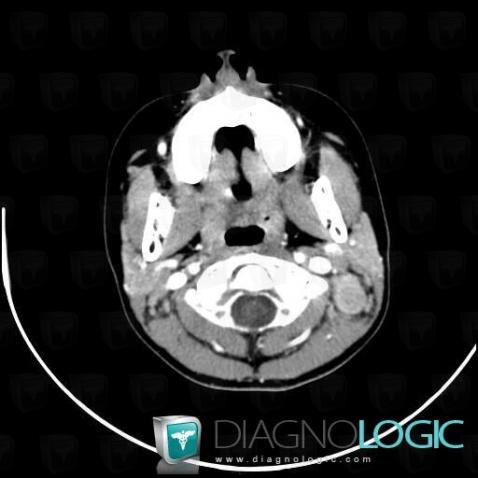 Lymphoma, Deep facial spaces, CT