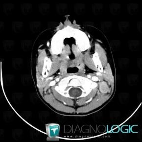 Lymphoma, Deep facial spaces, CT