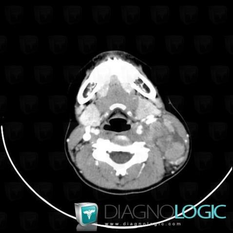 Lymphoma, Deep facial spaces, CT