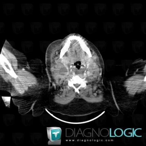 Lymphoma, Deep facial spaces, CT