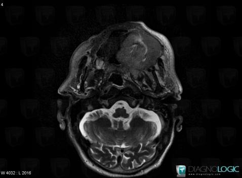 Lymphoma, Deep facial spaces, MRI