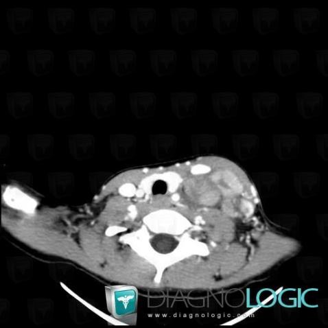 Lymphoma, Deep neck spaces, CT