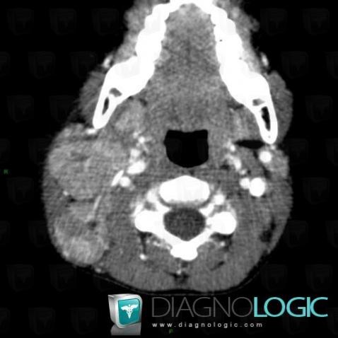 Lymphoma, Deep neck spaces, CT