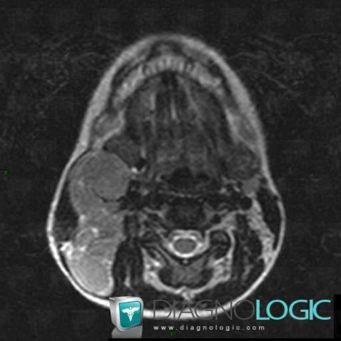 Lymphoma, Deep neck spaces, MRI