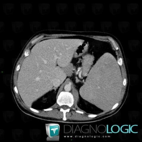 Lymphoma, Diaphragm, CT