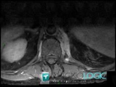 Lymphoma, Diaphragm, MRI