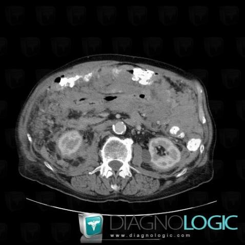 Lymphoma, Duodenum, Mesentery / Peritoneum, CT