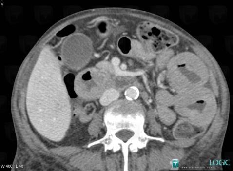 Lymphoma, Duodenum, Small bowel, CT