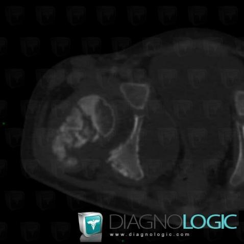 Radiology case : Lymphoma (CT) - Diagnologic