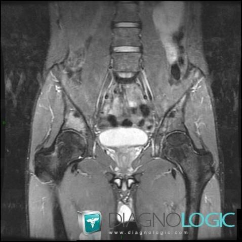 Lymphoma, Ilium, MRI