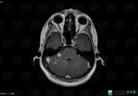 Lymphoma, Infratentorial peri cerebral spaces, MRI