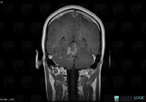 Lymphoma, Infratentorial peri cerebral spaces, MRI