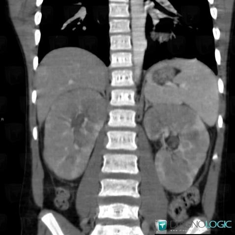 Lymphoma, Kidney, CT