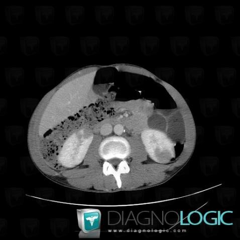 Lymphoma, Kidney, CT