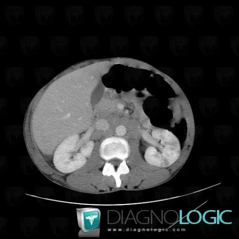 Lymphoma, Kidney, CT