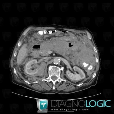 Lymphoma, Kidney, Retroperitoneum, CT