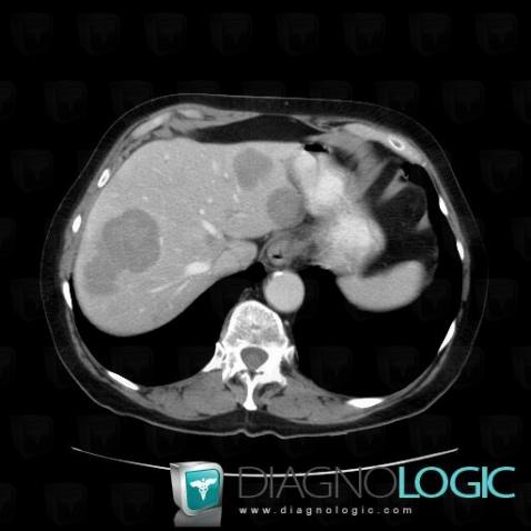 Lymphoma, Liver, CT