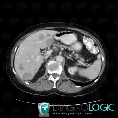 Lymphoma, Liver, CT