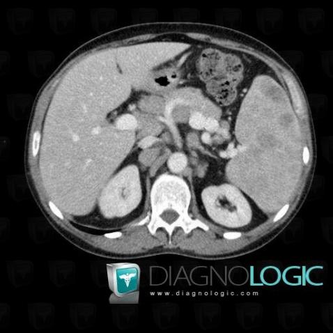 Lymphoma, Liver, CT