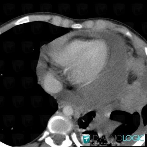 Lymphoma, Mediastinum, Cardiac cavities / Pericardium, CT