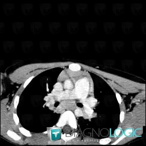 Lymphoma, Mediastinum, CT