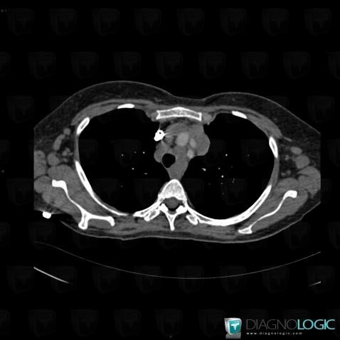 Lymphoma, Mediastinum, CT