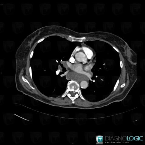 Lymphoma, Mediastinum, CT