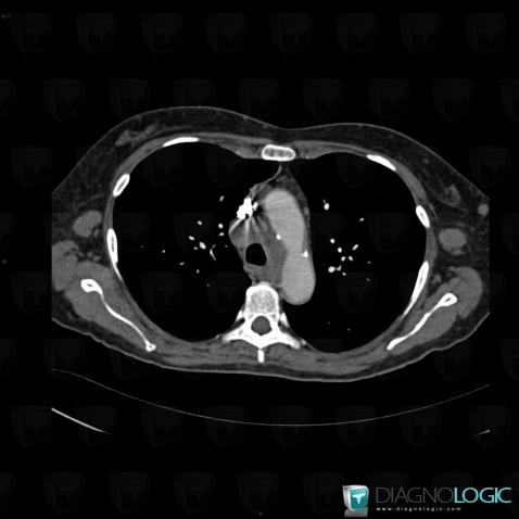 Lymphoma, Mediastinum, CT