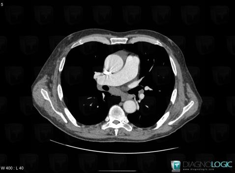 Lymphoma, Mediastinum, CT