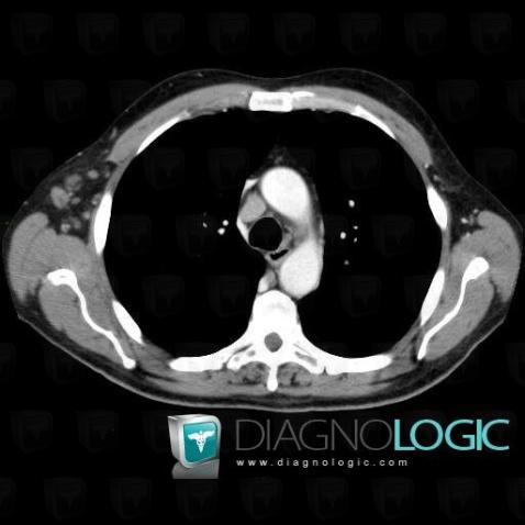 Lymphoma, Mediastinum, CT