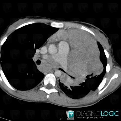 Lymphoma, Mediastinum, CT