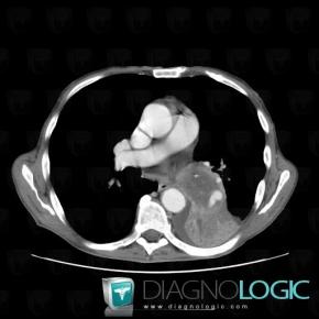 Lymphoma, Mediastinum, CT
