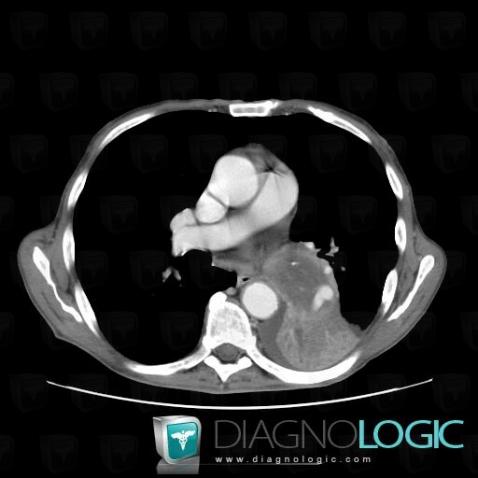 Lymphoma, Mediastinum, CT