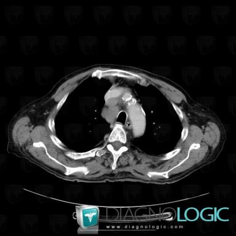 Lymphoma, Mediastinum, CT