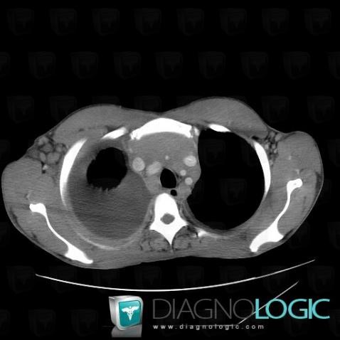 Lymphoma, Mediastinum, CT