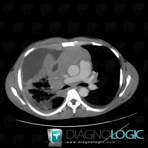 Lymphoma, Mediastinum, CT