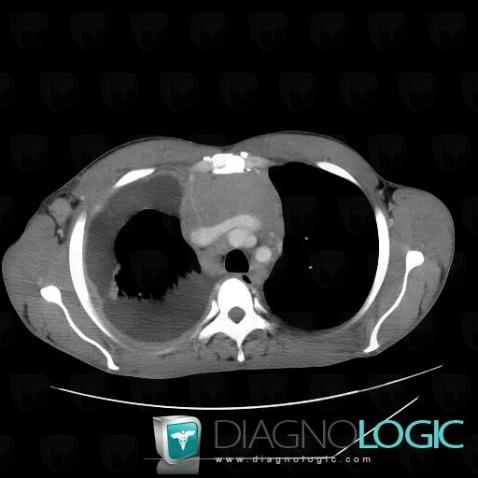 Lymphoma, Mediastinum, CT