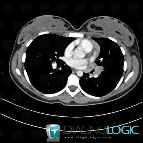 Lymphoma, Mediastinum, CT