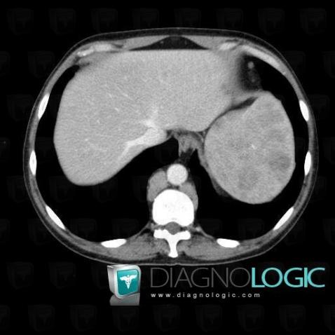 Lymphoma, Mediastinum, Paraspinal, CT