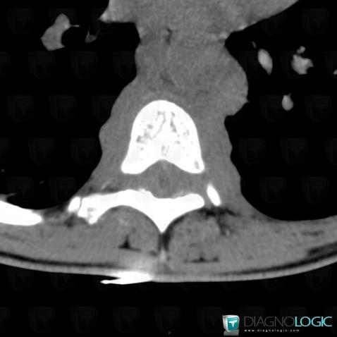 Lymphoma, Mediastinum, Spinal canal / Cord, CT