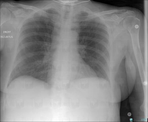 Lymphoma, Mediastinum, X rays