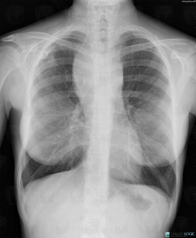 Lymphoma, Mediastinum, X rays