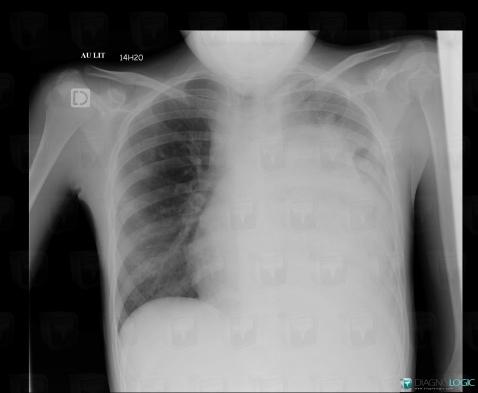 Lymphoma, Mediastinum, X rays