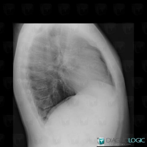 Lymphoma, Mediastinum, X rays