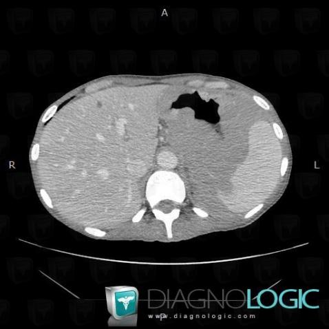 Lymphoma, Mesentery / Peritoneum, CT