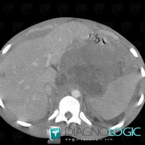 Lymphoma, Mesentery / Peritoneum, CT