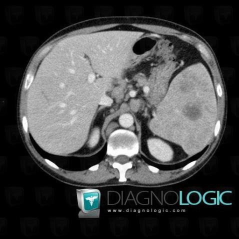 Lymphoma, Mesentery / Peritoneum, CT