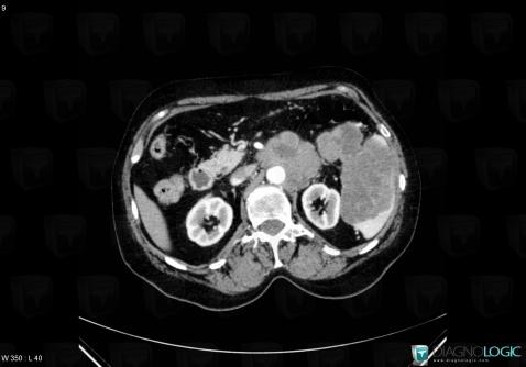 Lymphoma, Mesentery / Peritoneum, CT