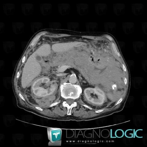 Lymphoma, Mesentery / Peritoneum, CT